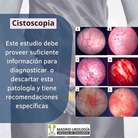 madrid urologia cistoscopia  cistitis intesticial diagnostico dolor
