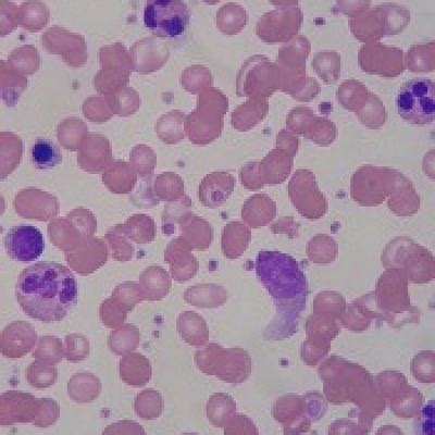 drug wont advance  phase   ss thalassemia mdedge hematology