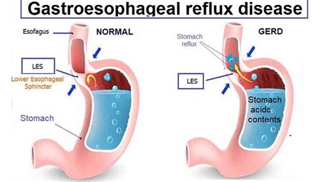 gastroesophageal reflux disease gerd  helal medical