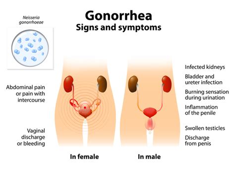 Antibiotic Resistance Is Complicating Gonorrhea Treatment