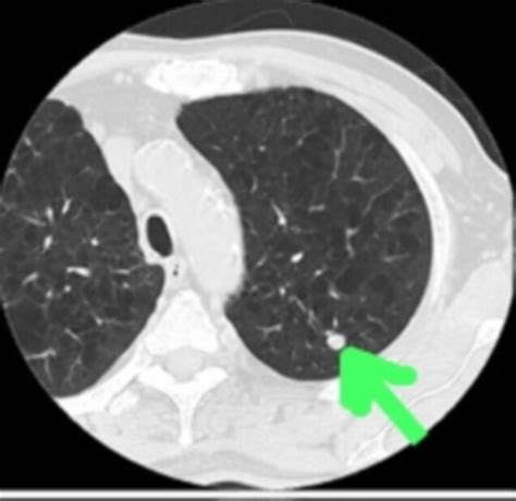 News Article Ct Scans For Lung Cancer Turn Up Few False