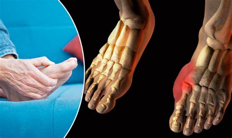 gout symptoms treatment and diet foods to avoid and what to drink health life and style