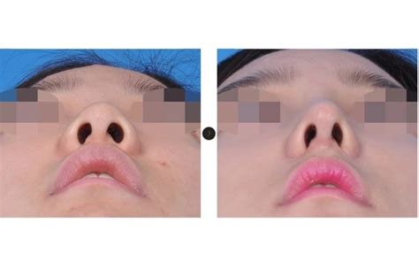 blunt nose  rhinoplasty surgeon  korea hanabi rhinoplasty clinic