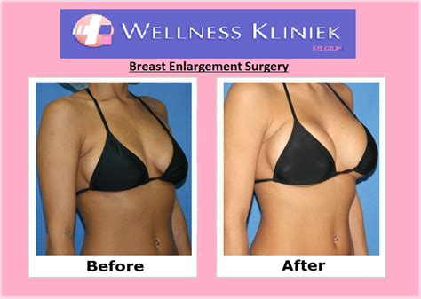 breast implants implants breast breast enlargement breast surgery
