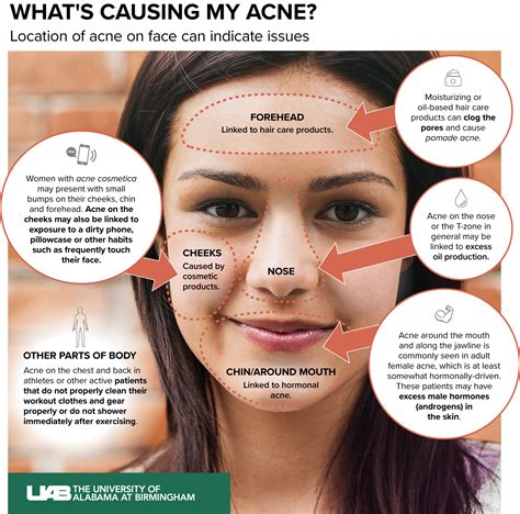 what causes acne on face my xxx hot girl
