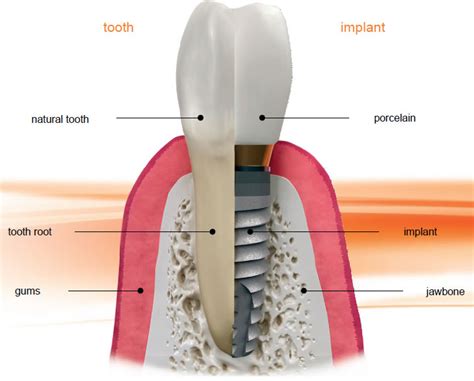 dental implants diagram wiringvio
