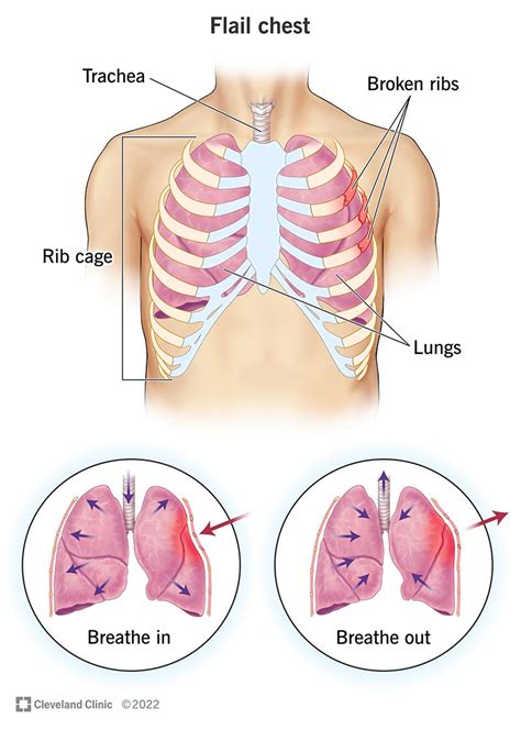 flail chest  symptoms diagnosis treatment
