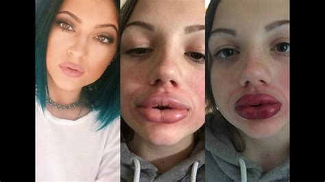 Kylie Jenner Lip Challenge Hodgetwins Youtube