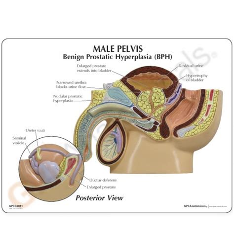 Male Pelvis Section Model With Bph 3552 Prostate