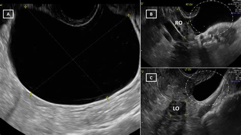 postsurgical peritoneal inclusion cyst masquerading as a large pelvic