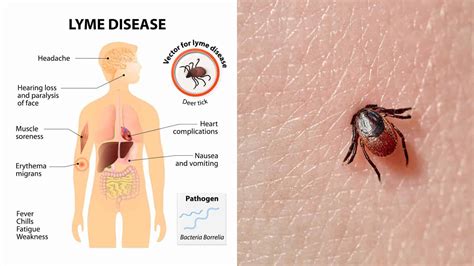 5 Warning Signs Of Lyme Disease To Never Ignore 6 Minute Read