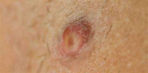 red lump anus warm photos and other amusements comments 4