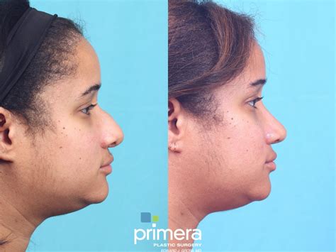 rhinoplasty    pictures case  orlando florida primera plastic surgery