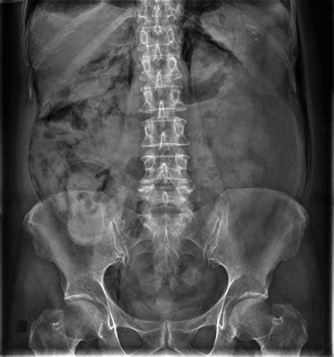 pneumoretroperitoneum abdominal x ray radiology case