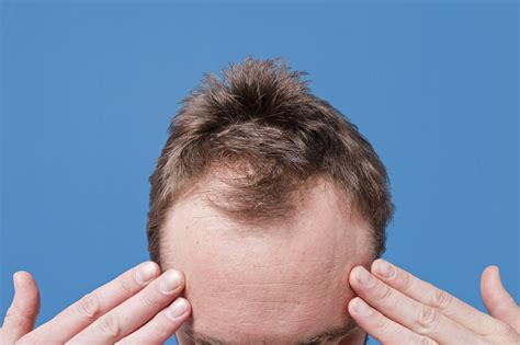 Hair Loss And Male Pattern Baldness Androgenetic Alopecia