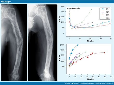 Pagets Disease Of Bone