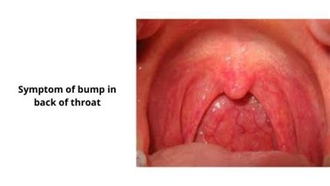 bump    throat  symptoms  treatment dailyhealthcurescom