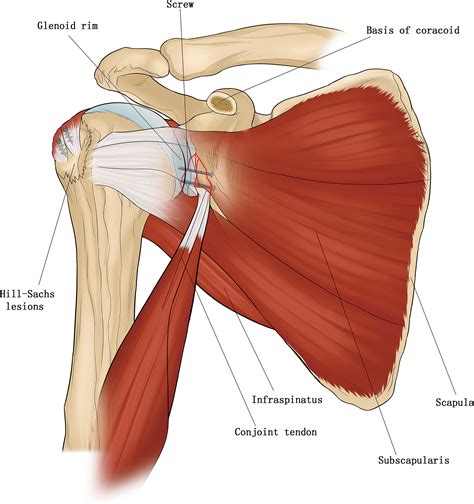 treatment  chronic anterior shoulder dislocation  coracoid