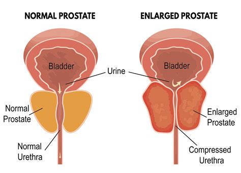 why men don t like to talk about their enlarged prostate