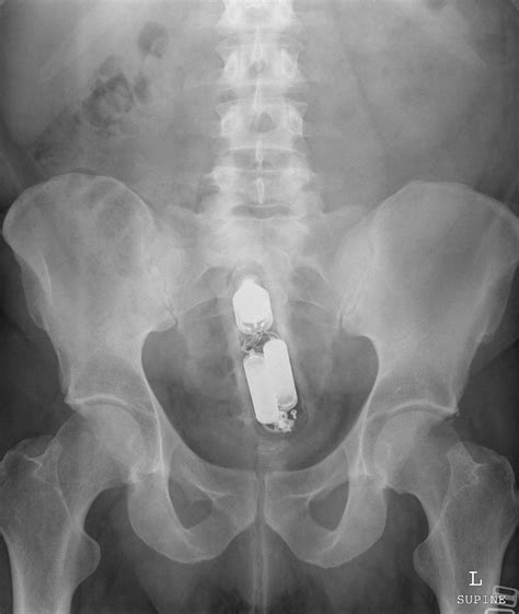 Young blog pain anal