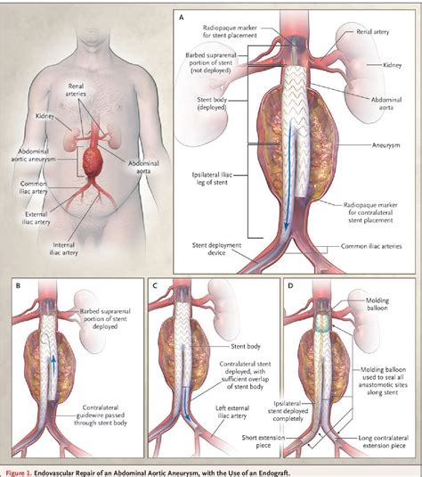 figure   endovascular repair  abdominal aortic aneurysm