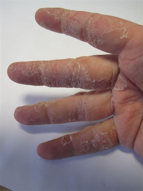 dry skin   hands  fingers  fingers