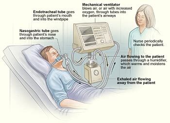 mechanical ventilation conventional  conventional studycom