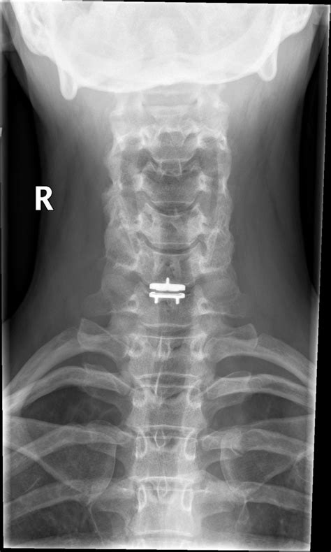 disc prosthesis buyxraysonline