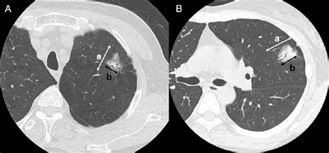 Findings Of Peripheral Lung Cancer On Thin Section Ct A B A