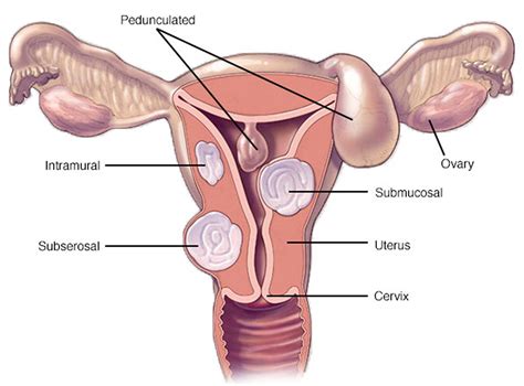 Uterine Fibroids Causes Symptoms Diagnosis Treatment And Pregnancy