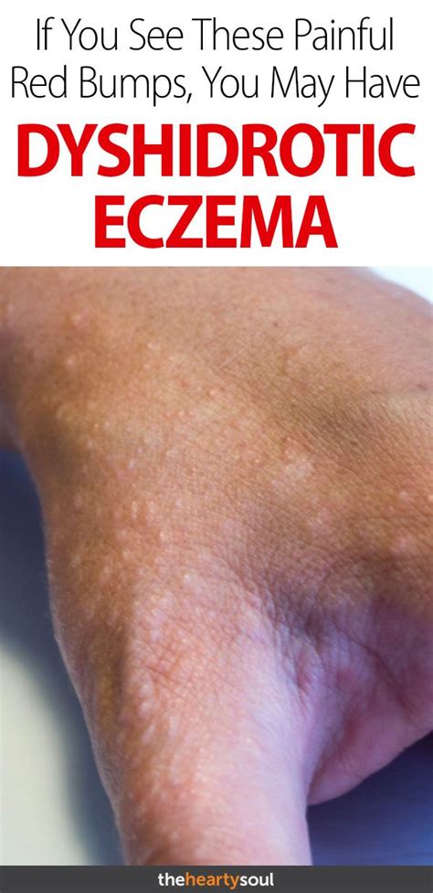 what is dyshidrotic eczema and how do you know if you have it skin