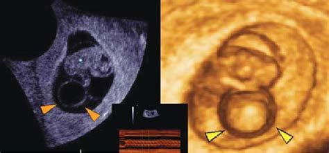 huge yolk sac leftd image  normal appearance  early embryo