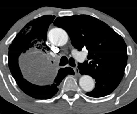 Lung Cancer Nsclc Encases The Right Upper Lobe Bronchus With Apical