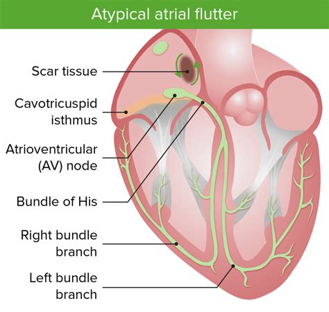 atrial flutter concise medical knowledge