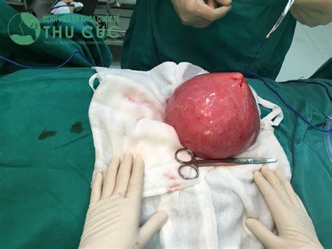Thu Cuc Hospital Successfully Performed Surgery For Removing 22 Cm