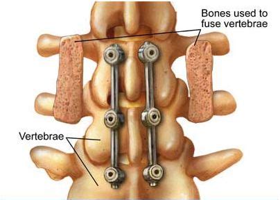 illustration  spinal fusion spinal fusion spinal fusion surgery  surgery