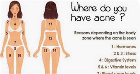 The Location Of Acne On Your Body Has A Secret Meaning You