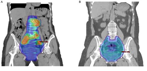 clinical outcome of extended‑field irradiation vs pelvic irradiation