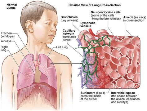 Hypersensitivity Pneumonitis Causes Symptoms Diagnosis Treatment