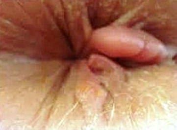 Pictures of anus after anal sex