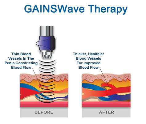 Gainswave Therapy For Ed