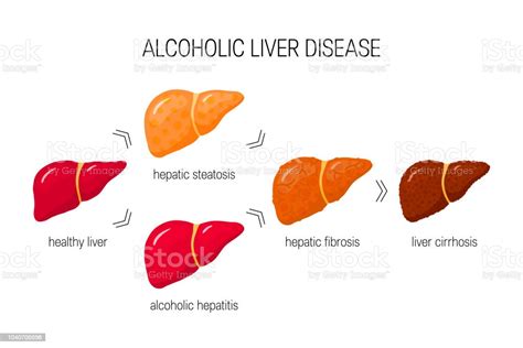 Alcoholic Liver Disease Vector Concept Stock Illustration Download