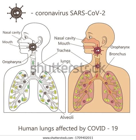 Vector Illustration Human Respiratory System Affected Stock Vector