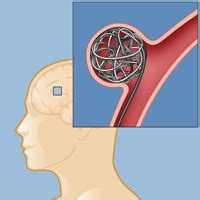 surgery  aneurysm weill cornell brain  spine center