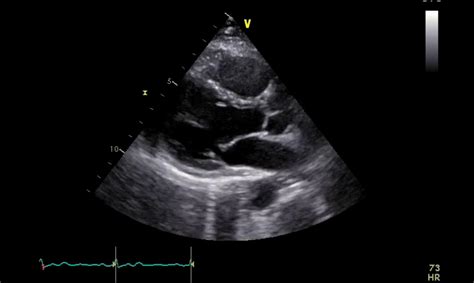 heart failure ultrasound