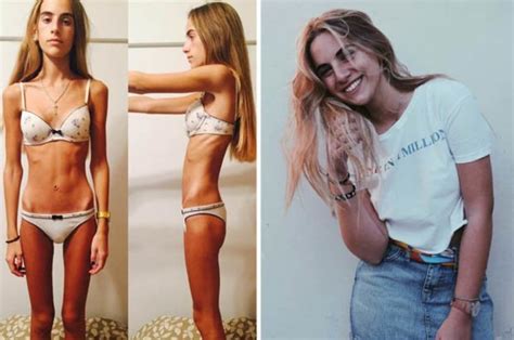 Teenager Who Weighed 5 5st During Anorexia Battle Shares Her Recovery