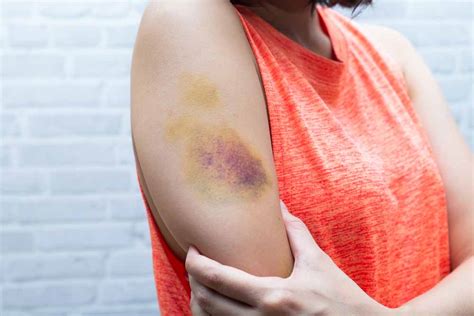 15 Signs And Symptoms Of Leukemia Every Woman Needs To Know