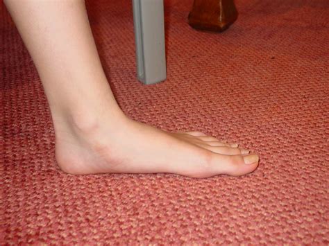 flat feet symptoms   risk factors home remedy