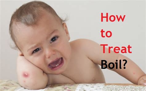 How To Treat Boil
