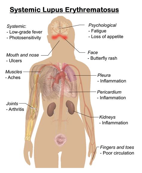 systemic lupus erythematosus sle medicoinfo